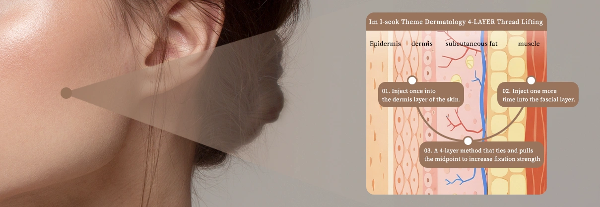 Simultaneous Fixation of 4 Anatomical Layers, Authentic Structural Lifting