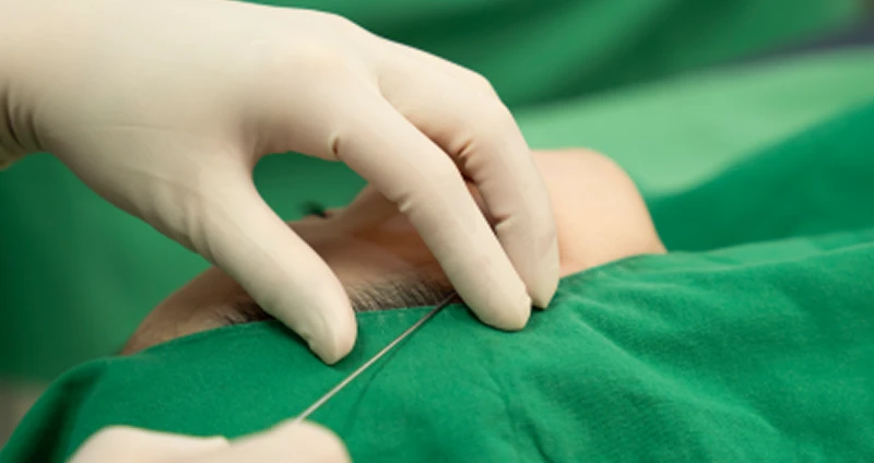 Limeeseok Theme Clinic’s Refined Thread Lifting Details