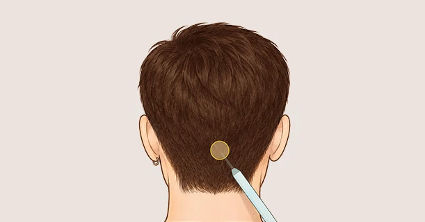 FUE Method