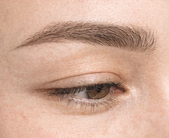 Eyebrow Transplant
