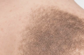 Becker’s Nevus