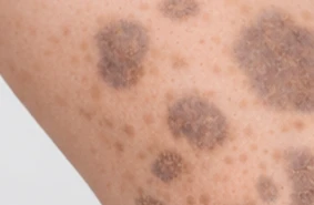 Nevus Spilus