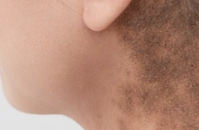 Riehl’s Melanosis