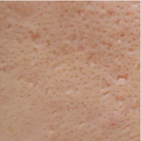 Icepick Scars