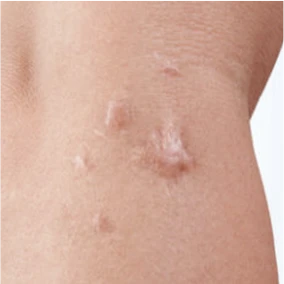 Keloid Scars
