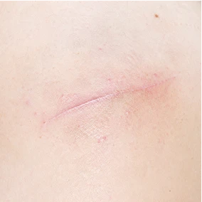 Traumatic Scars