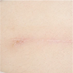 Surgical Scars