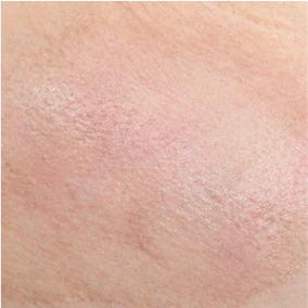Burn Scars
