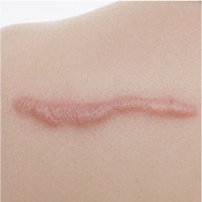 Hypertrophic Scars