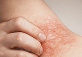 Atopic Dermatitis