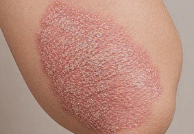 Psoriasis