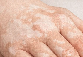Vitiligo