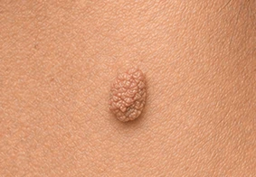 Warts