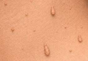 Skin Tags
