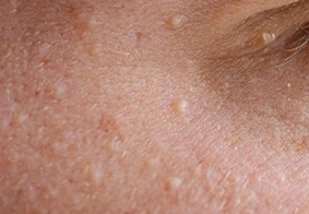 Syringoma