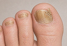 Nail Fungus