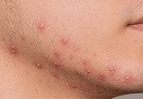 Folliculitis
