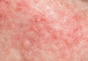 Seborrheic Dermatitis