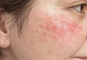 Contact Dermatitis