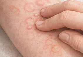 Urticaria
