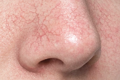 Telangiectasia