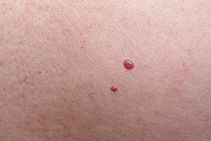 Hemangioma