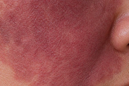 Port-Wine Stain