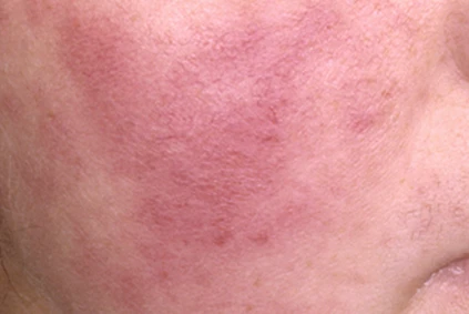 Facial Flushing / Thermal Redness