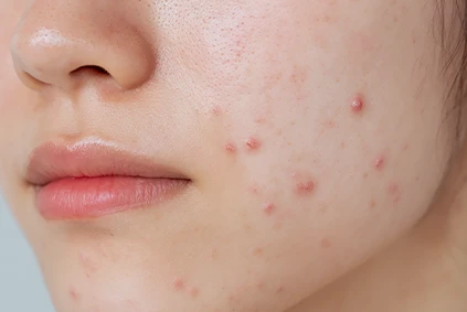 Vascular Acne