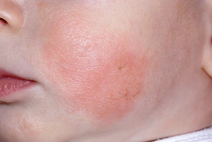 Vascular Nevus / Angioma
