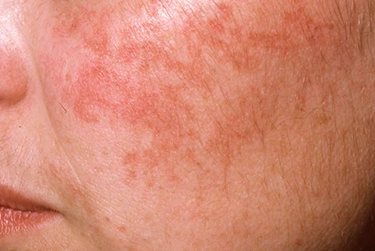 Rosacea
