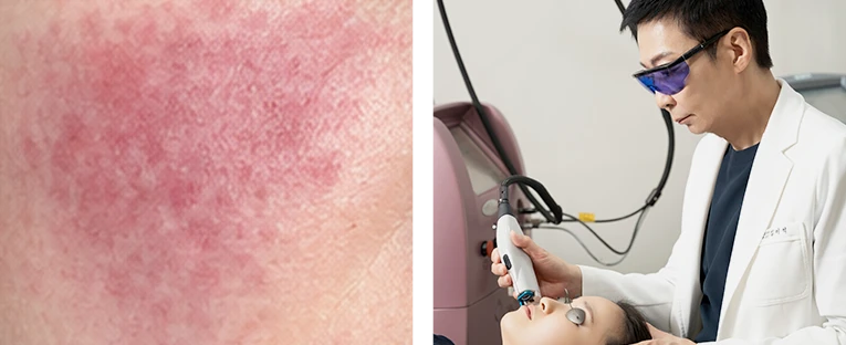 Delicate, Targeted Care to Calm Sensitive Skin and Correct Persistent Redness